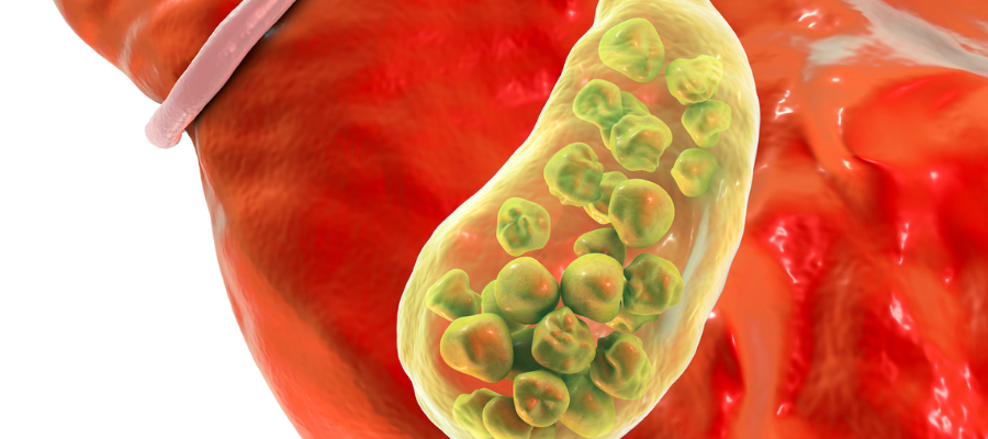Combatting Gallstones with Vitamin | OnPoint Vitamin Combatting Gallstones with Vitamin | OnPoint Vitamin